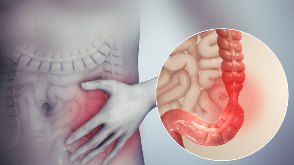 İrritabl Bağırsak Sendromu (IBS) Nedir?