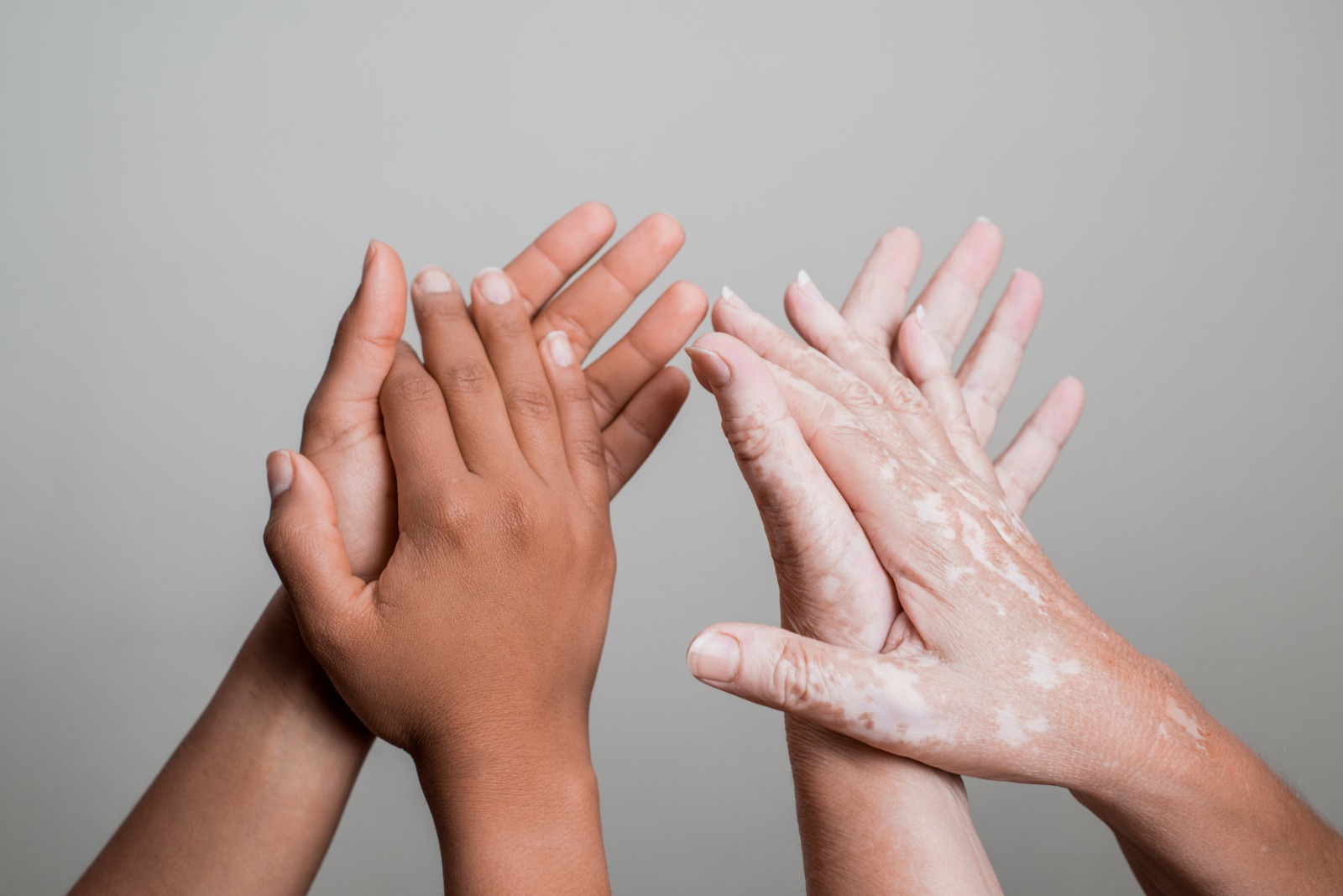 vitiligo hastalığı