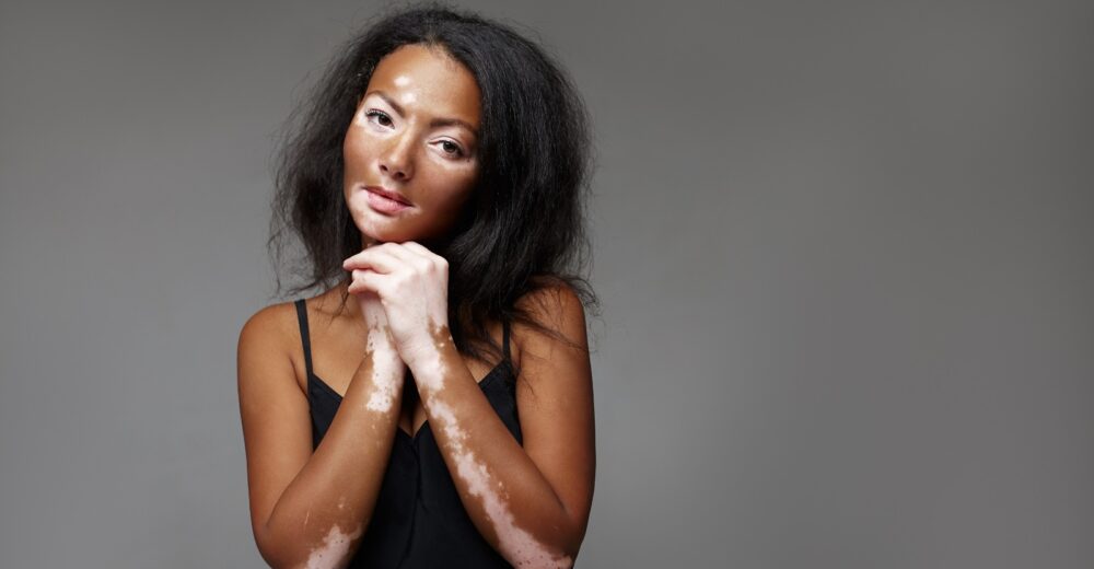 vitiligo hastalığı