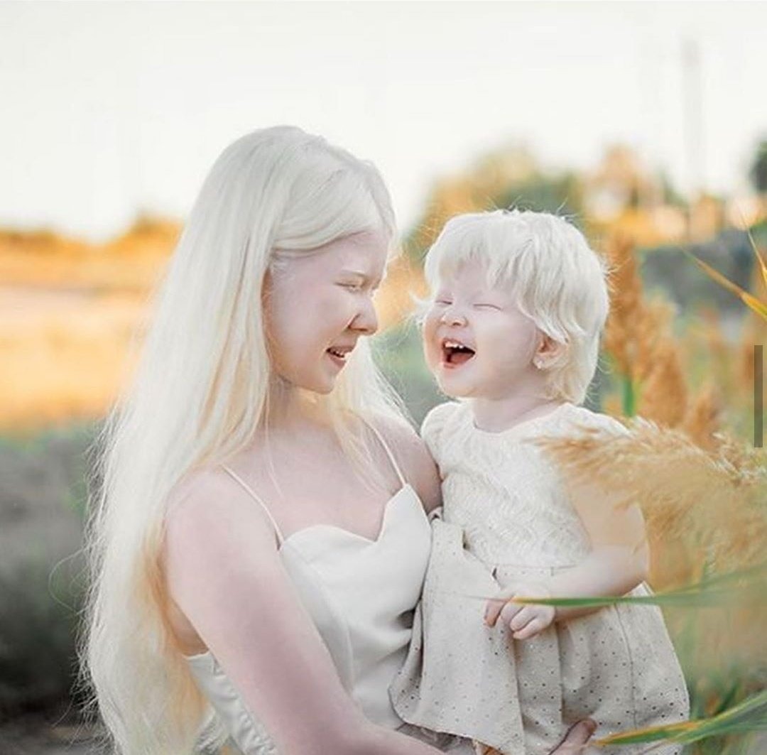 Albino Nedir?