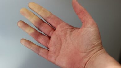 Raynaud Sendromu Nedir?