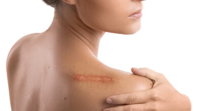 Keloid Nedir?